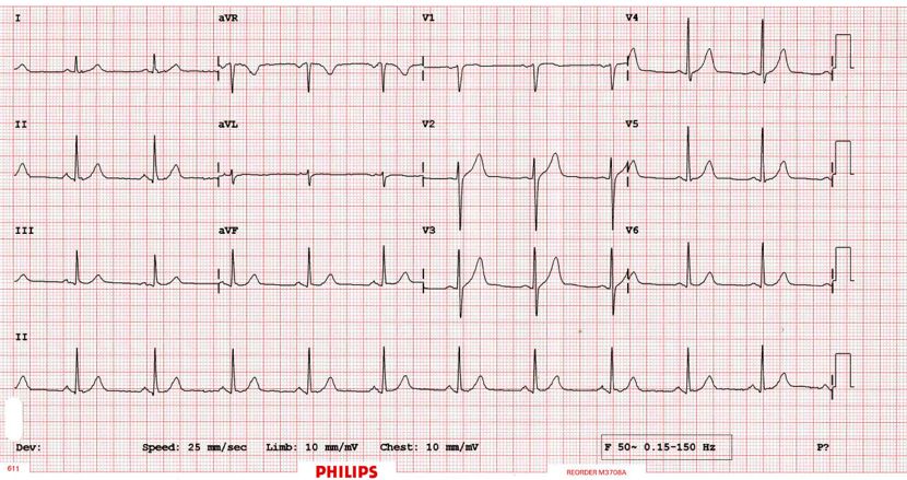   A normal ECG trace